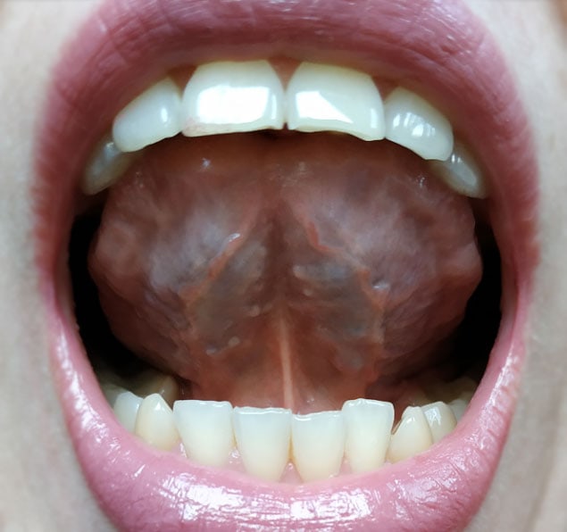 prawidłowa pionizacja języka