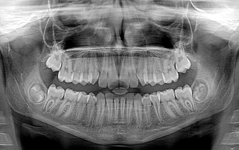 Czym jest trainer ortodontyczny?